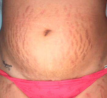 Striort – Antes Striort - Antes